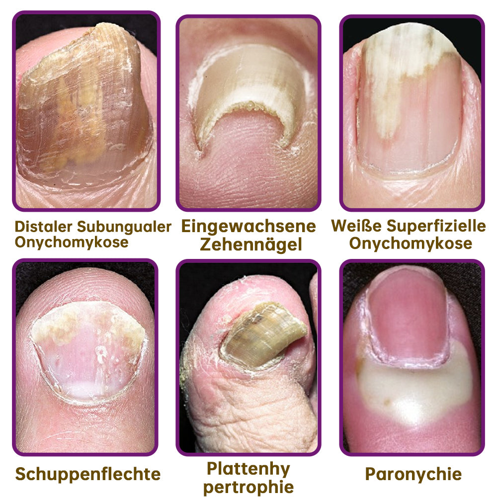1+1 GRATIS | 🛡️ PilzSchutzschild™ – Sag Nagelpilz den Kampf an!