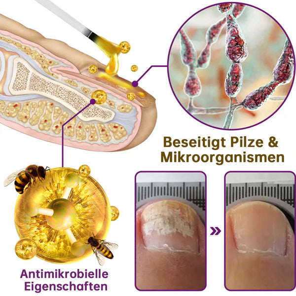 1+1 GRATIS | 🛡️ PilzSchutzschild™ – Sag Nagelpilz den Kampf an!