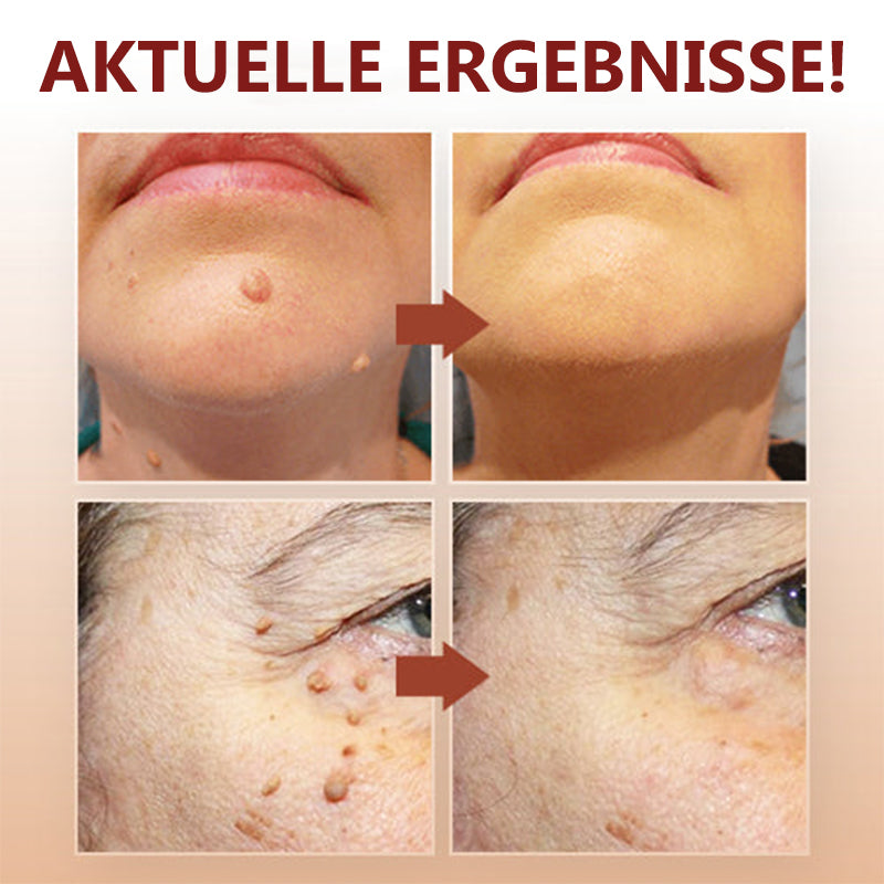 1 + 1 GRATIS | Essenz zur Entfernung von Flecken und Muttermalen