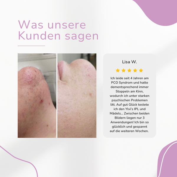 Venzani Ylvis IPL Hair Remover I Die führende Laser-Haarentfernung für Zuhause