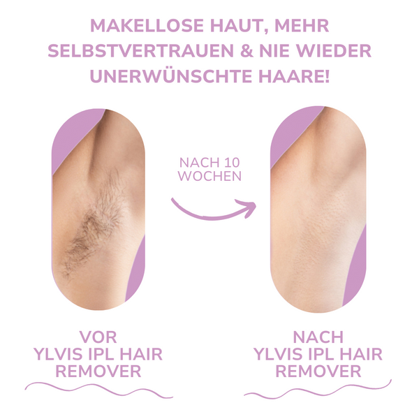 Venzani Ylvis IPL Hair Remover I Die führende Laser-Haarentfernung für Zuhause